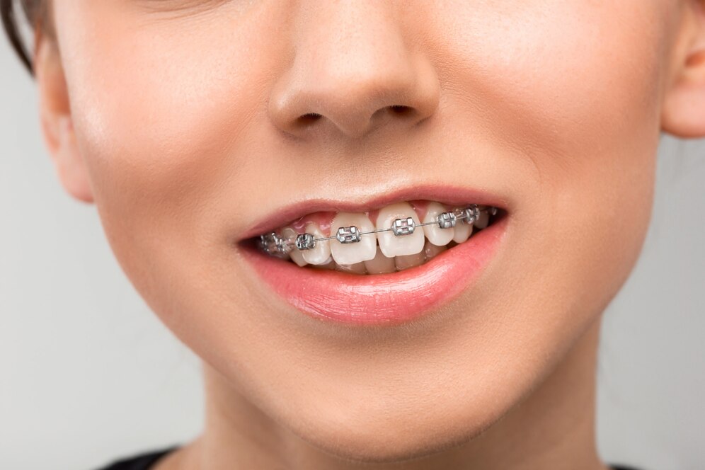 Orthodontic braces treatment