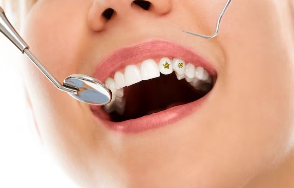 Gold and diamond tooth cosmetic treatment