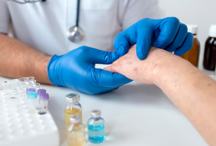 Skin allergy treatment