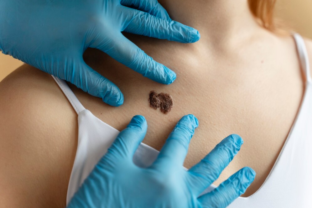 Mole removal treatment