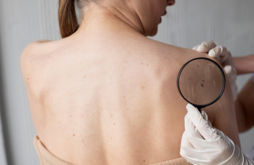 Warts removal treatment