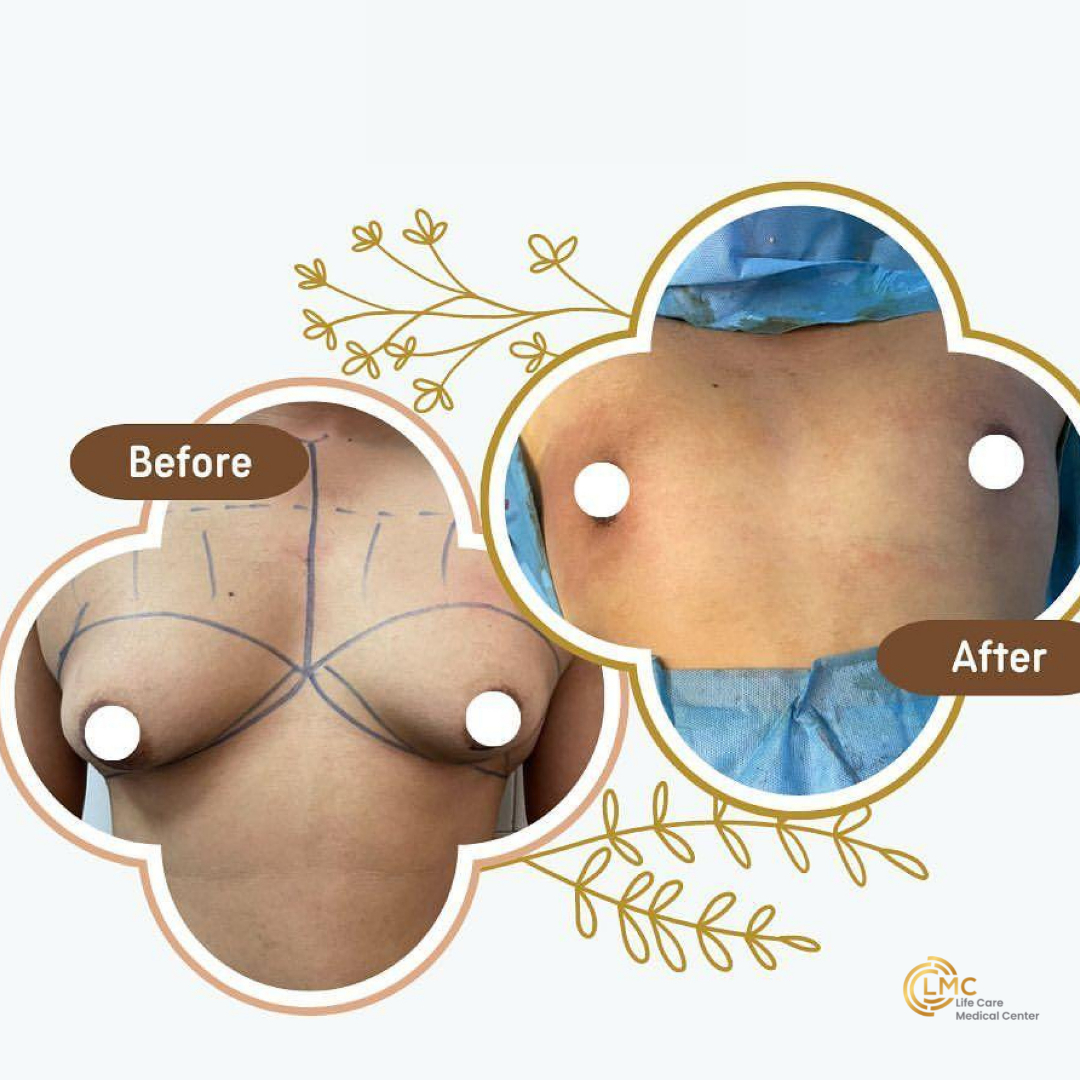 lmc plastic-surgery